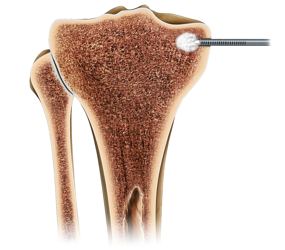 procedure