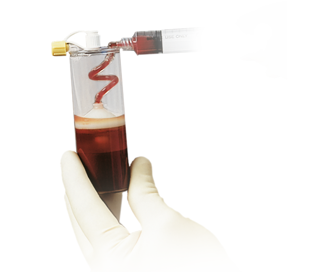BioCUE Blood and Bone Marrow Aspiration (bBMA) Concentration System from Zimmer Biomet BioCUE Blood and Bone Marrow Aspiration (bBMA) from Zimmer Biomet